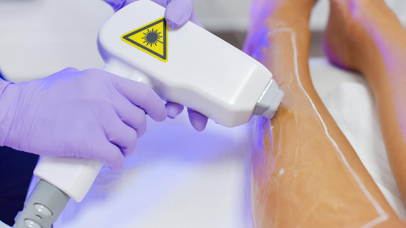 Emla, crema anestética